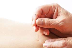 Acupuncture